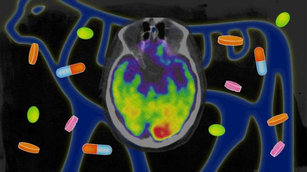 Novo Nordisks kronjuvel, molekylet semaglutid, kan måske alligevel have en virkning mod Alzheimers sygdom.