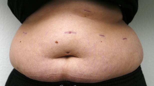 Novo Nordisk tror på fedmesucces trods covid-19. Arkivfoto: Ritzau Scanpix