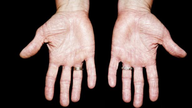 Dansk biotekselskab undersøger orismilast som tabletbehandling til behandling af blandt andet eksem Arkivfoto: Betina Garcia/Ritzau Scanpix