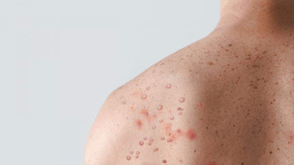 Abekopper giver et boblende udslæt, og kun danske Bavarian Nordic har en vaccine. Arkivfoto: Jozef Polc/PA Images/Ritzau Scanpix